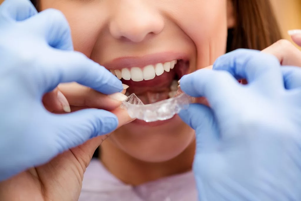 Gutiere transparente Invisalign pentru tratamentul ortodontic la clinica Dentetico Brașov