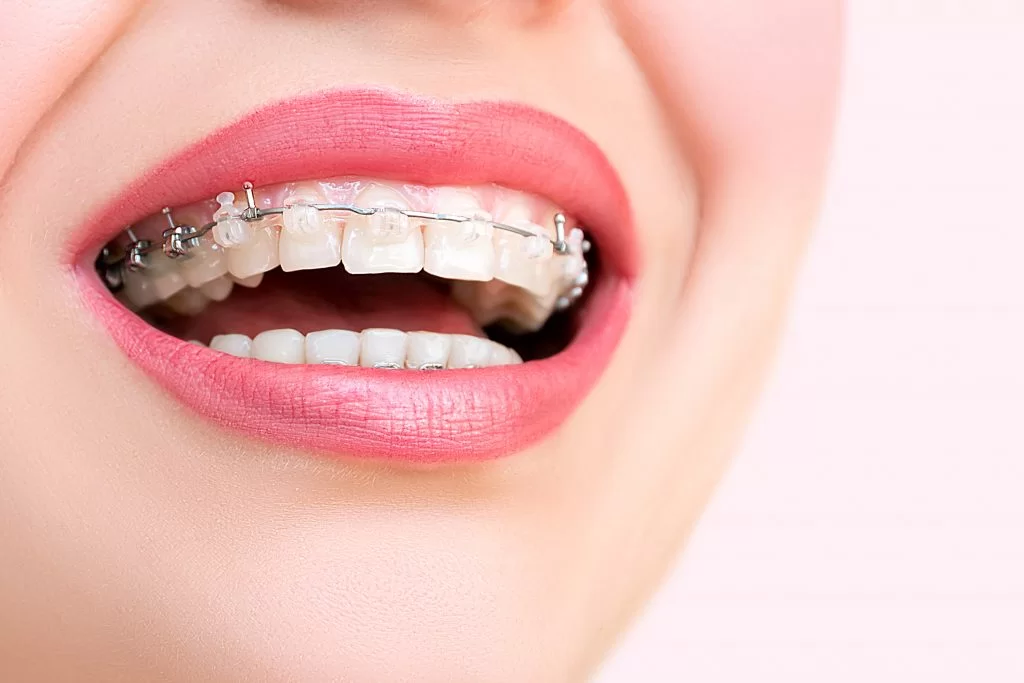 Etapele tratamentului cu aparat dentar ceramic la clinica Dentetico Brașov