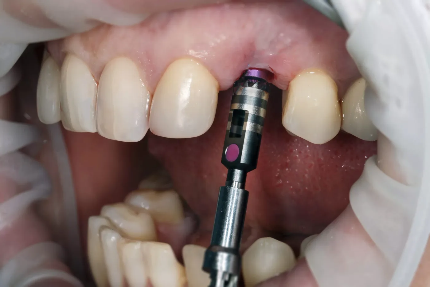 Implantul dentar: etapele integrării lucrărilor pe implanturi. Dentetico îți explică pas cu pas