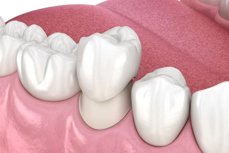 coroane dentare brașov 1