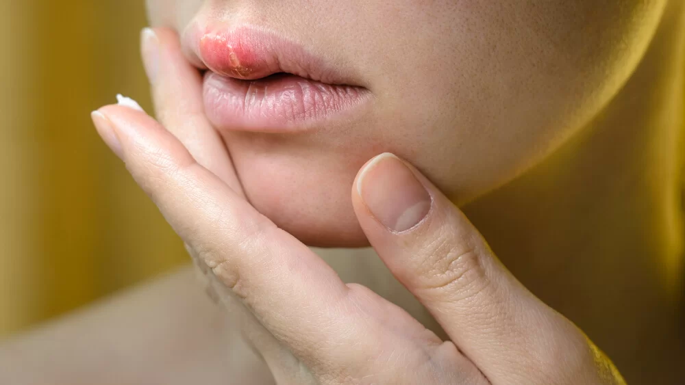herpes bucal