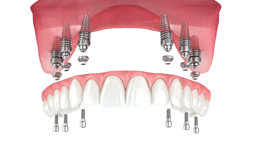 Atasarea protezei fixe peste implanturile dentare Fast & Fixed