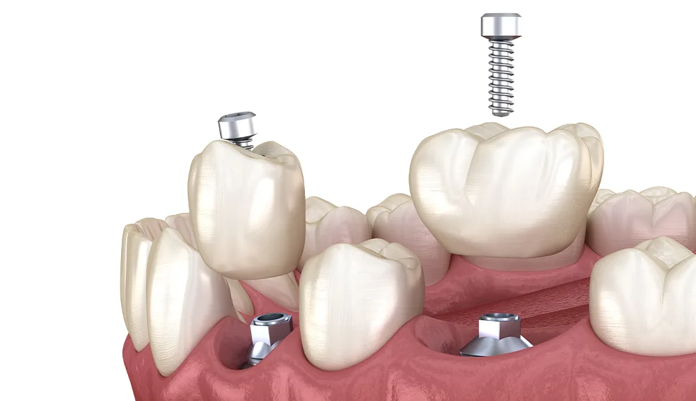 Clinica stomatologică Dentetico Brașov Implanturi dentare 2