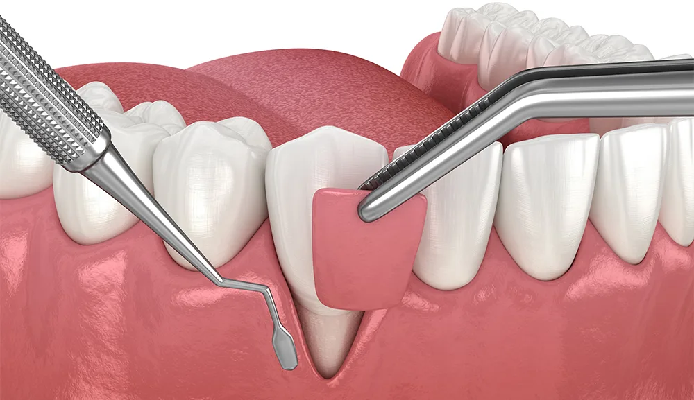 Clinica stomatologica Dentetico Brasov chirurgie dentara 2