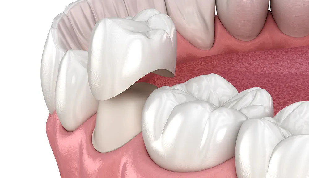 Coroană dentară aplicată pe un dinte natural — clinica Dentetico Brașov
