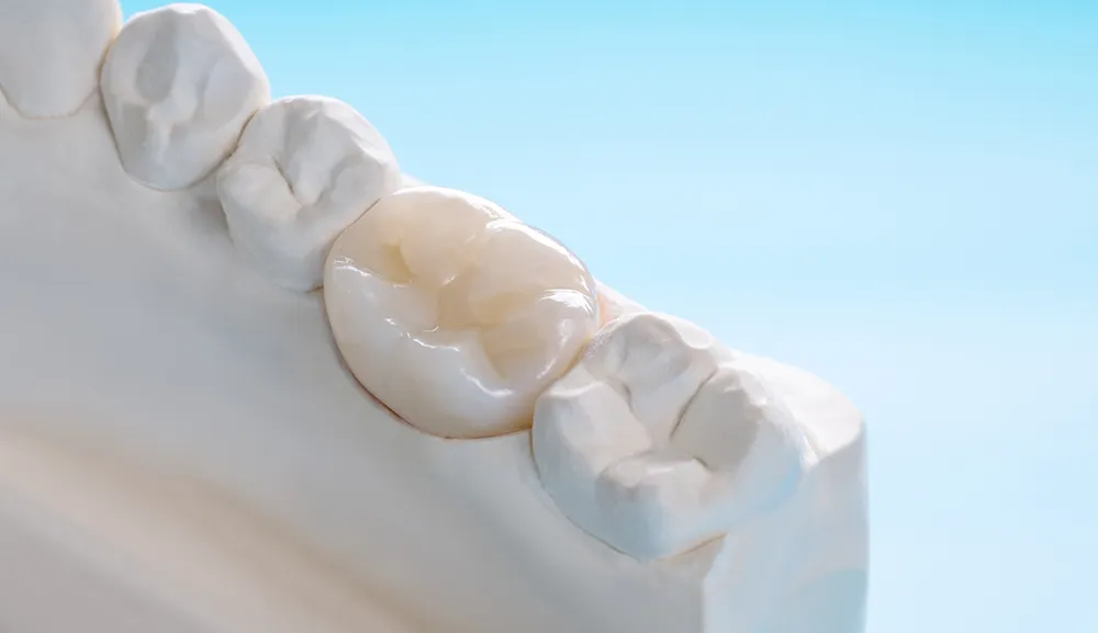 Coroană dentară ceramică pe model — clinica Dentetico Brașov