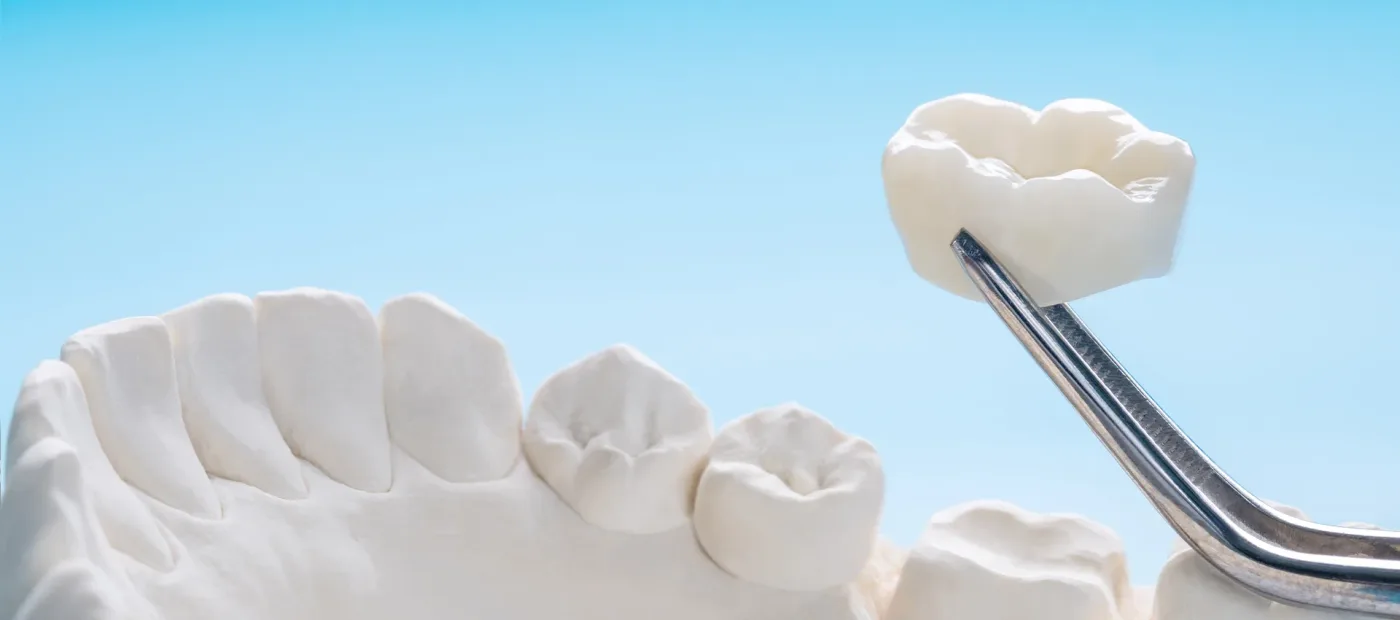 Coroane dentare la Dentetico — estetică dentară