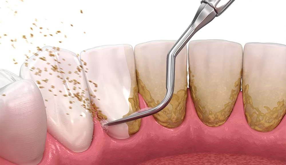 Terapie parodontală cu laserul dentar la Dentetico Brașov