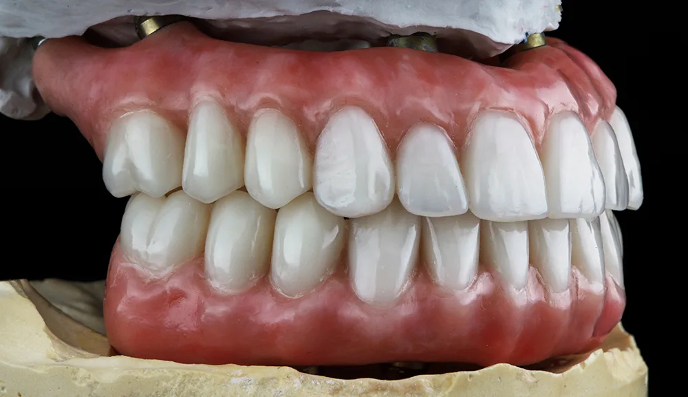 Proteză dentară totală pe model de lucru, realizată la Dentetico Brașov