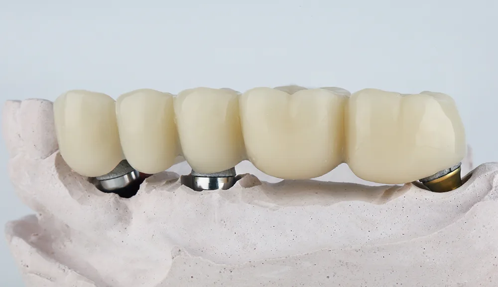 Tipuri de punți dentare disponibile la Dentetico Brașov