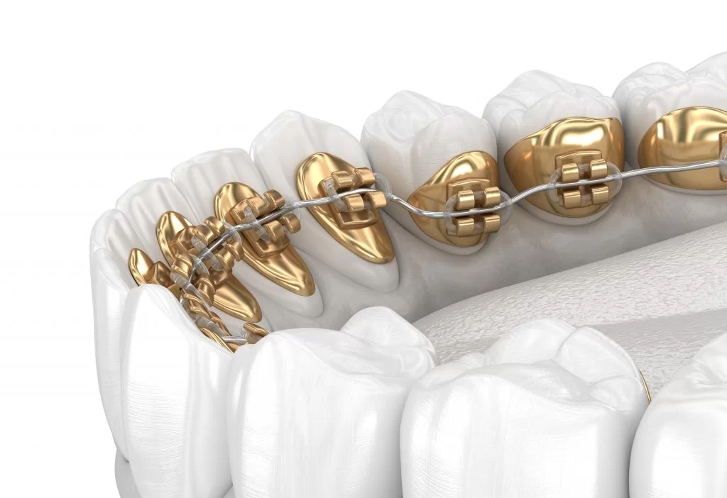 simulare grafica aparat dentar fixat pe dantura