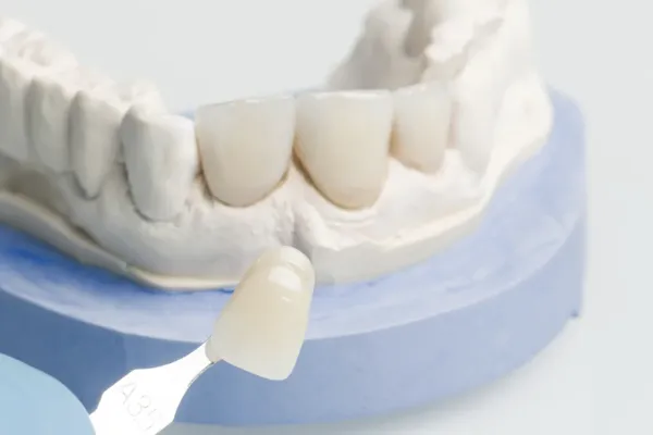 Coroane dentare pe suport din zirconiu la clinica Dentetico Brașov