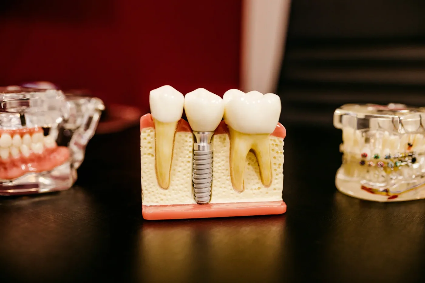 mulaj dinti cu coroane dentare
