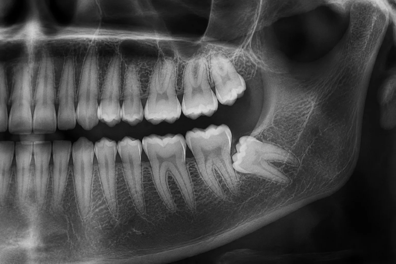 masea de minte inclusa vazuta pe radiografie la clinica dentetico