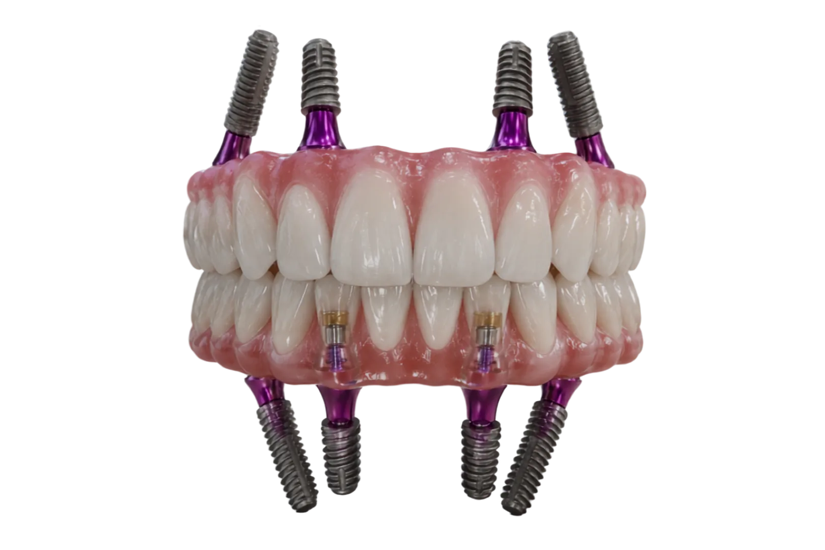 Clinica stomatologică Dentetico Brașov, tratament Fast & Fixed cu implanturi dentare