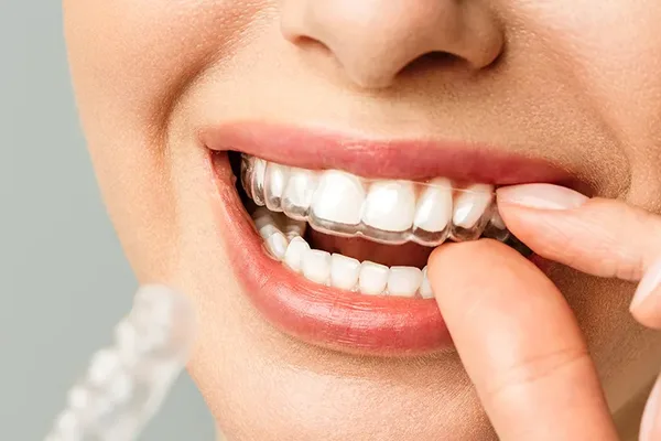 Pacientă care își aplică gutiera transparentă, aparat dentar invizibil la clinica Dentetico Brașov