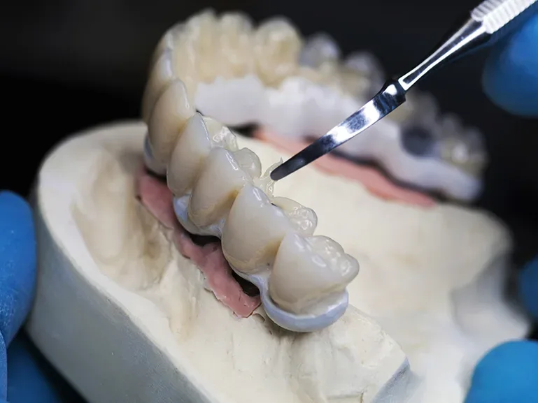 Proteză dentară pe model, în etapa de finisare în laborator, la Dentetico Brașov