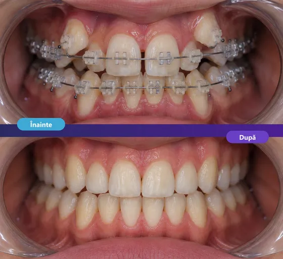 Tratament ortodontic cu aparat dentar estetic la Dentetico Brașov, înainte și după (4)