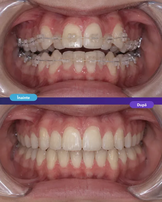 Tratament ortodontic cu aparat dentar estetic la Dentetico Brașov, înainte și după (5)